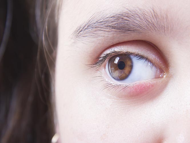 You Woke Up With Swollen Eyes or Eyelids? Don't Panic!