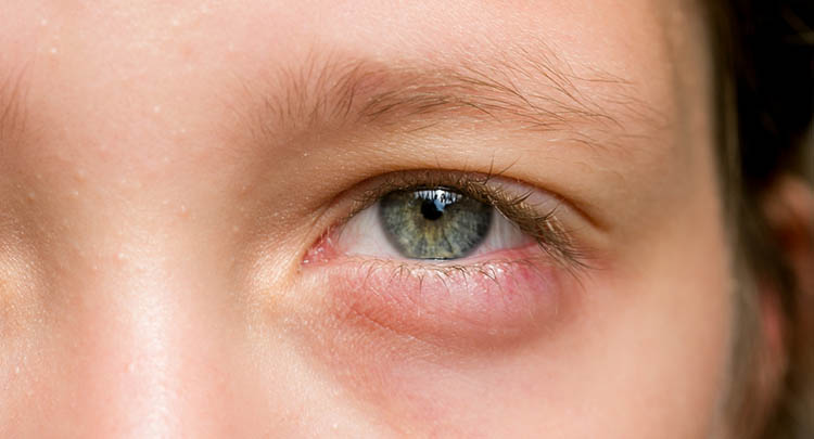  TOP 10 EXPLANATIONS FOR SWOLLEN EYES