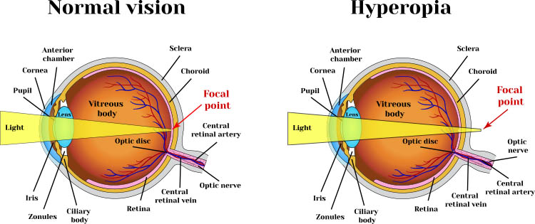 What Type Of Lens Does A Farsighted Person Need