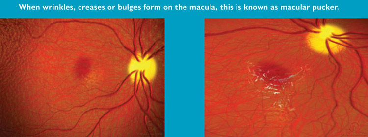 Macular pucker