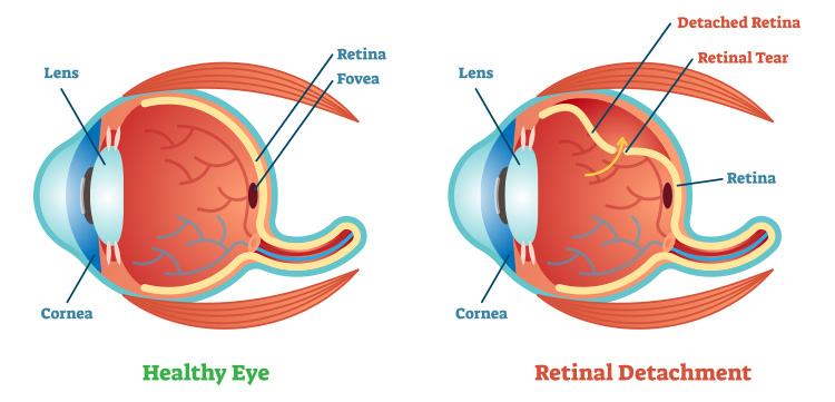 Retinal Detachment
